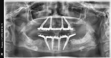 Что такое имплантация All on 4 all on 4 имплантация рентген